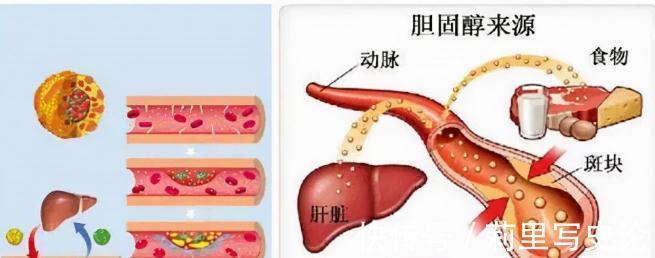 疫苗|“血脂疫苗”正式启用了，每年只需注射两次，什么人都可以打？