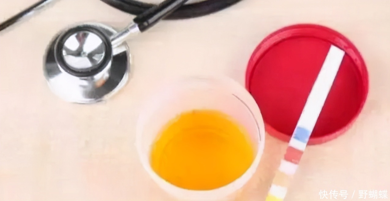 男子|男子不喝酒,尿酸高达720,查出肾衰竭,提醒:这2样东西害人不浅