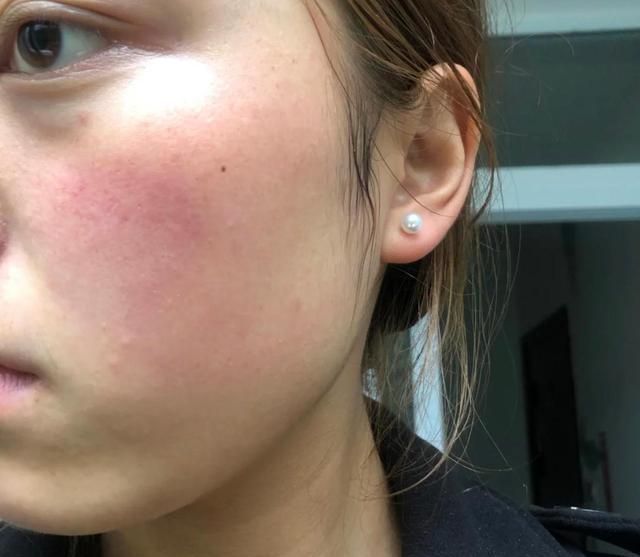 红血丝|判断你是不是“敏感肌”?看脸上这几个地方,很简单就能看出来!