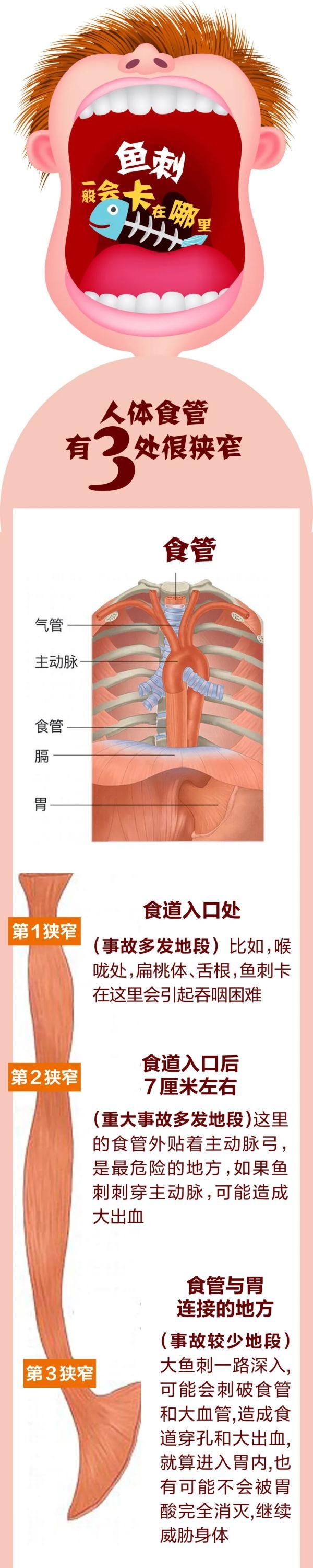 腘动脉|吞了根鱼刺，竟从膝盖后窝取出！她经历了什么？