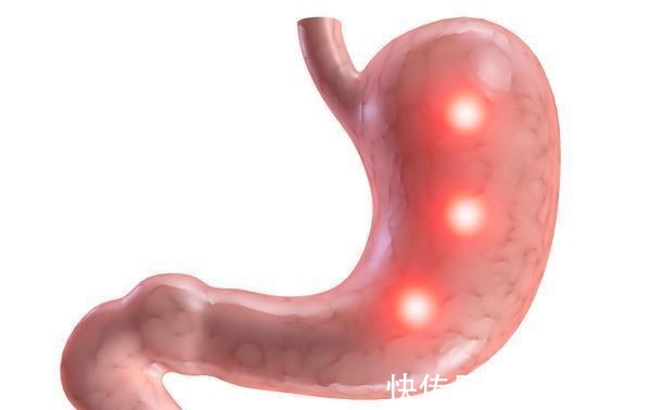 病情|胃癌患者,除了治疗,这5个措施也要重视,才能事半功倍