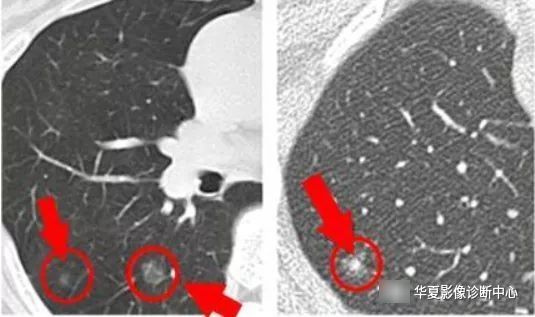 患者|从肺结节到肺癌，10个月影像记录，提醒我们正确对待肺结节处理