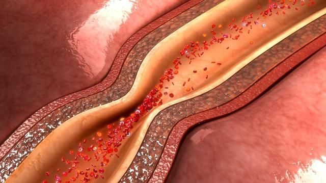 静脉|这“3物”，堪称血管清理工，每天换着吃，血管通畅更健康