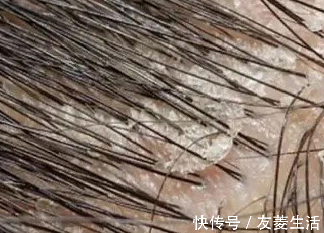 洗头|早上刚刚洗的头发怎么又油了？到底是怎么回事？