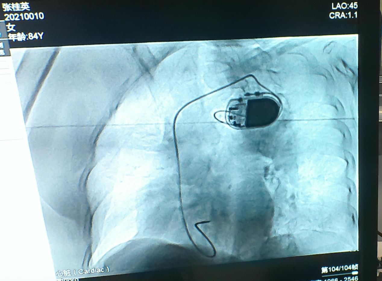 介入科|临沂凯旋医院介入科心脏起搏器安装手术成功完成