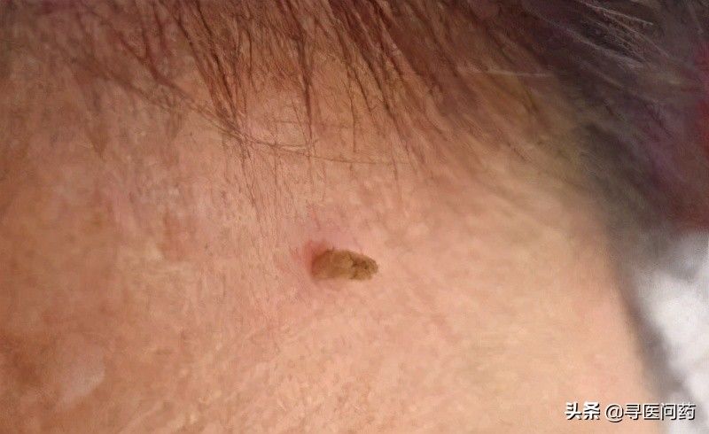 脖子|脖子上的小揪揪别拔，当心是HPV感染，越拔越多