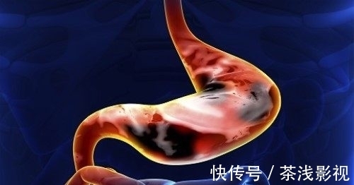 tff蛋白|23岁男子熬夜成瘾,胃病转胃癌,医生:睡前2事是“祸根”