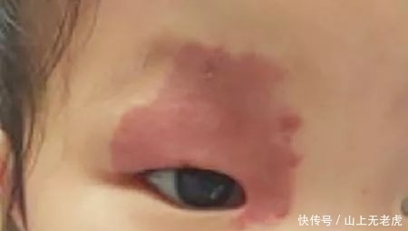 屁股|为什么很多新生宝宝屁股上都有“淤青”?答案在这!快来看看