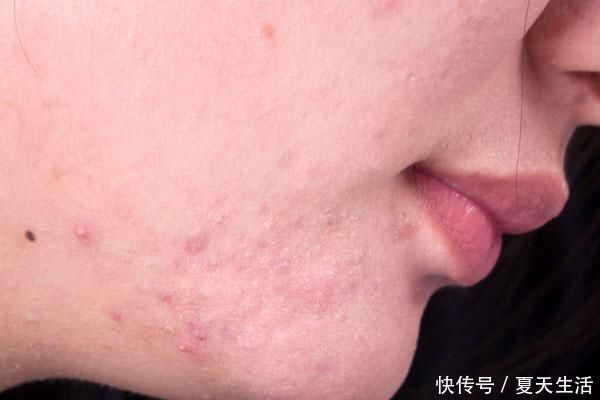 脸部螨虫过多,脸上会有哪些变化教你四招,螨虫一点点被消灭