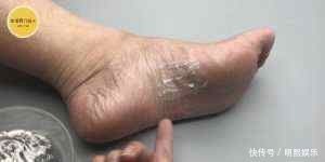 阿司匹林加牙膏,作用好厉害,解决了好多人一大困扰,告知家里人