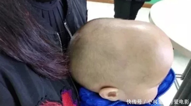 外星人|7个月宝宝头型像外星人,妈妈以为睡姿不正,医生却说必须手术