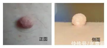 老年朋友|老年朋友注意了！身上长的“小肉粒”都是什么？千万别抠