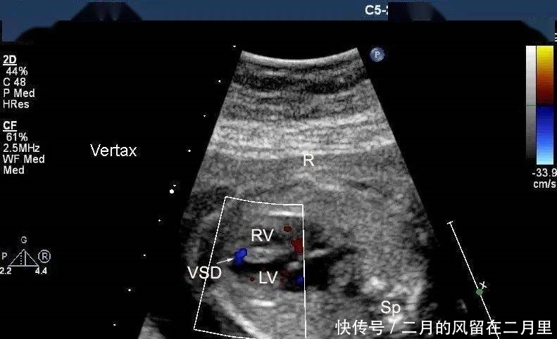 胎儿室缺,超声医师心中的痛