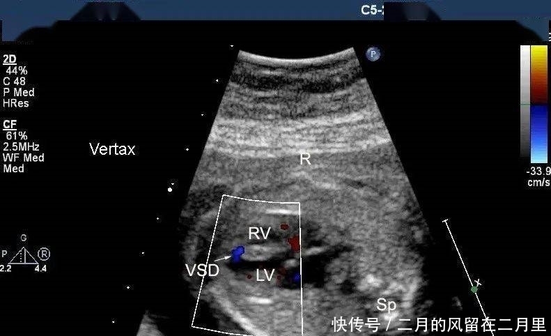  胎儿室缺，超声医师心中的痛
