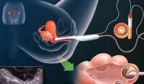 小蝌蚪们|进入女性体内,没和卵子相遇的小蝌蚪去哪了?答案非常有意思