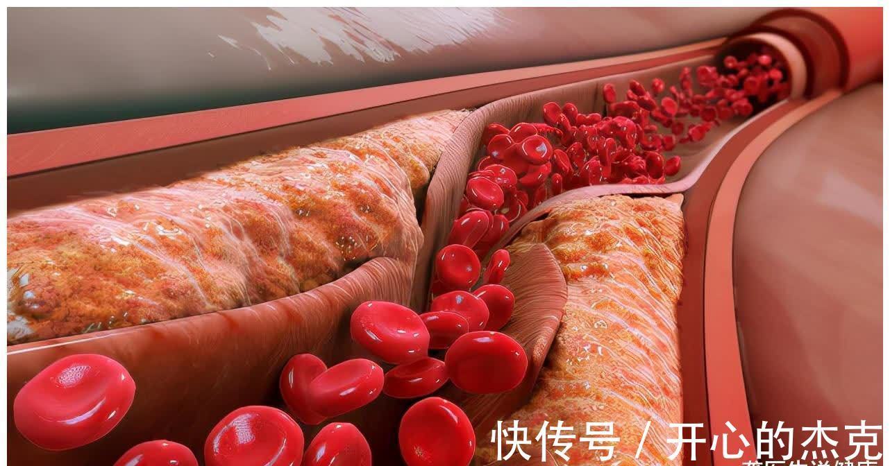 血管|60岁大爷爱吃“1物”,血管越“洗”越干净,高血脂或也绕道走