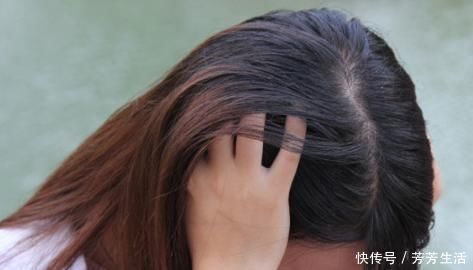 头皮里扣出“白泥”?不是头皮屑那么简单,以下几个问题要重视