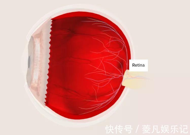 黄斑变性|10年糖尿病,眼睛快看不见了,生酮饮食几个月就好
