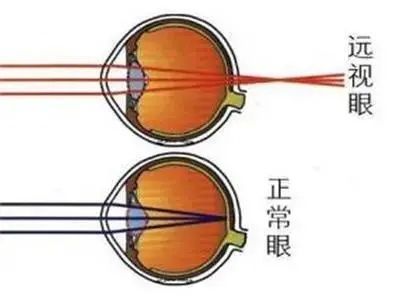 远视|佩戴老花镜的常见误区，避免老花眼加深，提高生活质量~