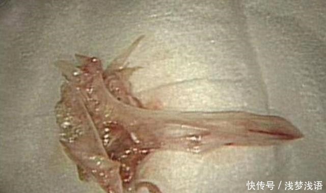 菲菲|男孩胃里发现一团“胶”,幕后真凶是这种“健康饮食”,脊背发凉!