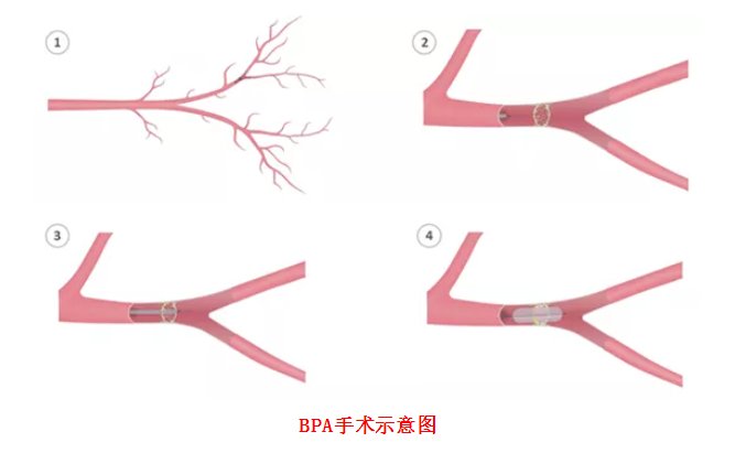 医学|用心攀登医学高峰 潍坊这家医院成功完成一例肺动脉球囊成形术