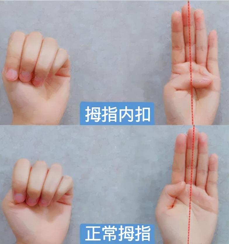 孩子|脑瘫孩子的治疗越早越好,怎么能早期发现孩子的异常呢?