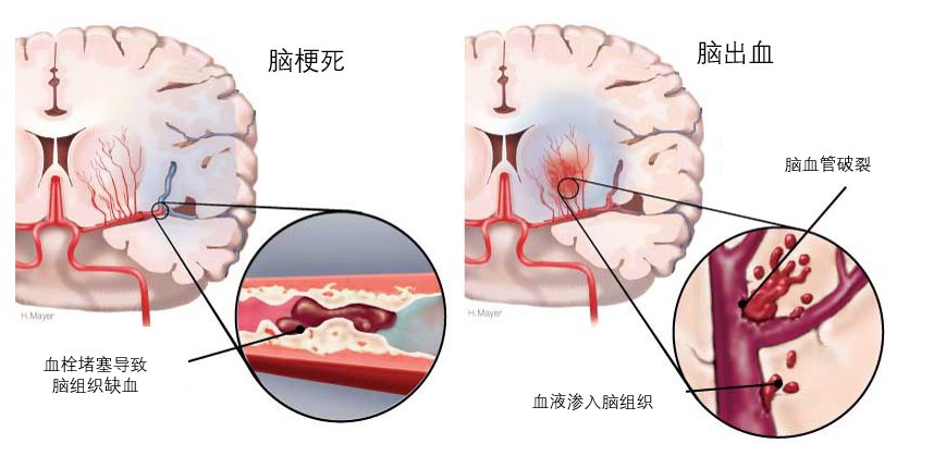 头痛|【健哥说心脏】脑出血和脑梗死有什么区别？