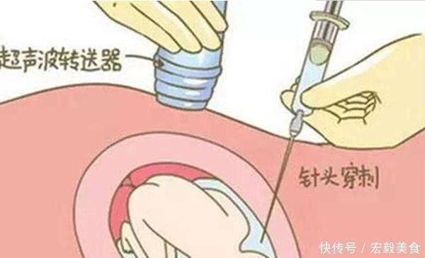 孕妈|孕期5大“排畸”检查,其中3项每个孕妈都要做,快看你落下了哪个