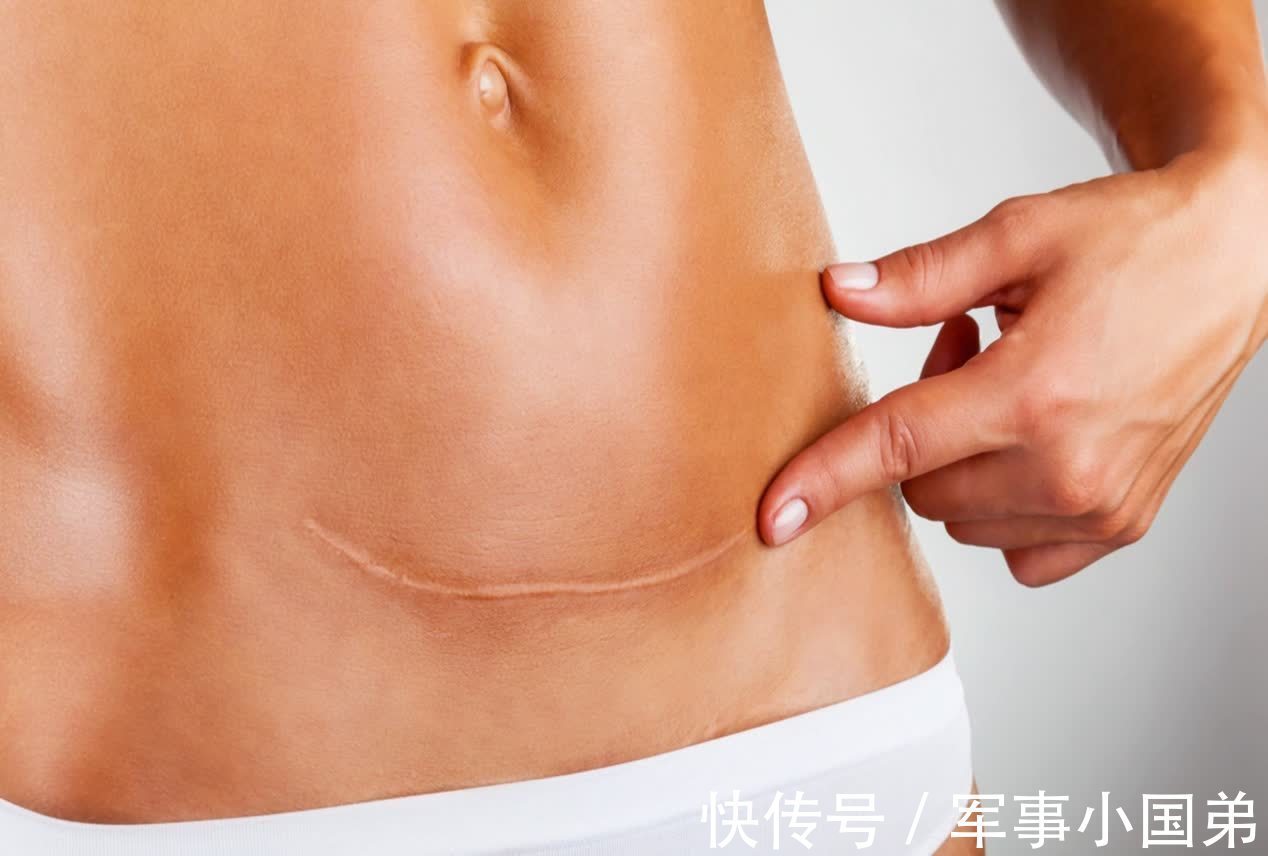 小李|首胎剖腹产,生二胎时要注意三个问题,一不小心就容易留下后遗症