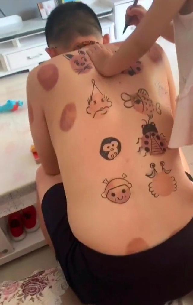 妞妞|爸爸拔完火罐回到家,下一秒女儿的这一举动,网友直呼:太有才