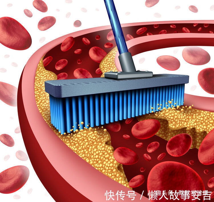 心脑血管|男子连续脑梗3次,都是爱吃惹得祸,高血脂不想脑梗,应该怎么吃