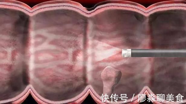 黑斑息肉|此部位长了痣,最好去检查一下大肠,大肠息肉可能已经找上了