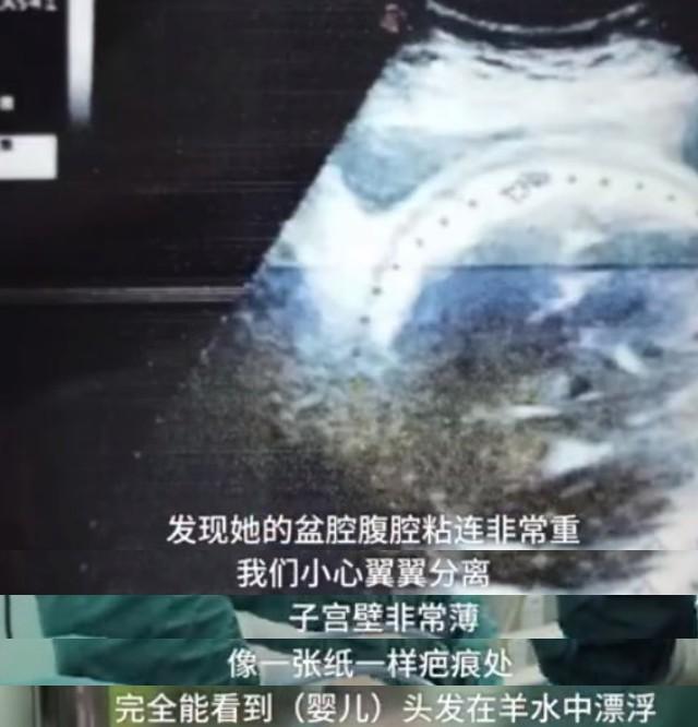 孕产妇|33岁产妇10年剖宫产4次,子宫已薄如纸张,听闻女胎还要生第5胎