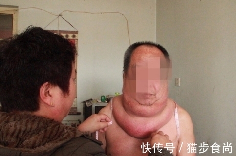 脖子|53岁大叔脖子粗成“水桶”,看起来样子很可怕,只因为疏忽一件