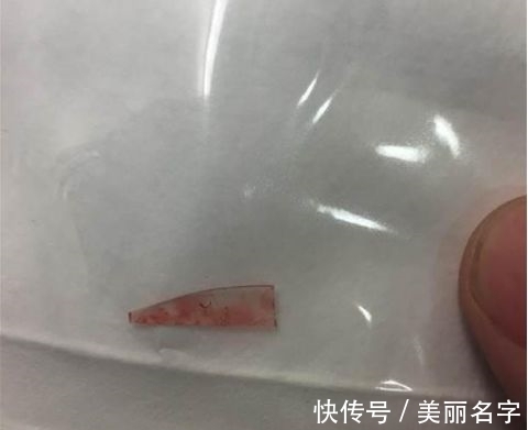 手臂|男子手臂有小肿块未在意,感觉疼痛后就医,取出的东西令人不冷静