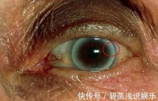 降血脂|血脂高不高,看脸上三个地方就知道,降血脂:四种食物一口别吃