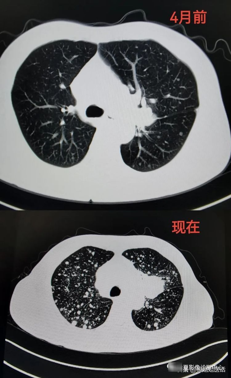 患者|从肺结节到肺癌，10个月影像记录，提醒我们正确对待肺结节处理