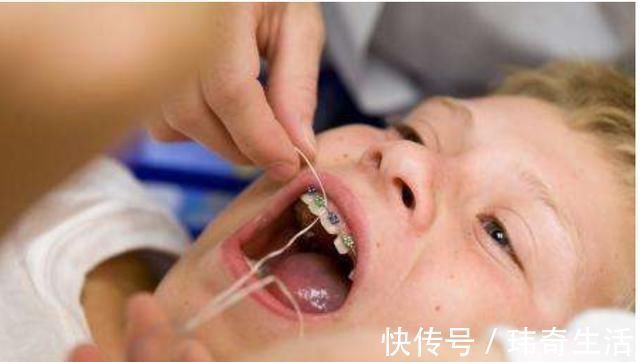 龋齿|宝宝长了一口“鲨鱼牙”，妈妈无奈送医求助，医生：怪家长无知