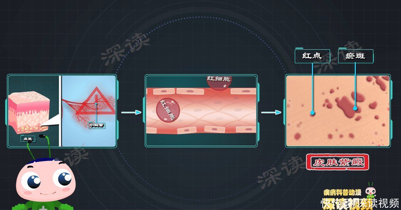 通透性|从腿上小红疹到血尿、蛋白尿，过敏性紫癜是咋搞出肾损伤的？