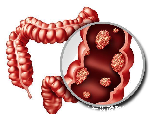 肿瘤|结直肠癌不能手术了？这些药物治疗可以了解一下