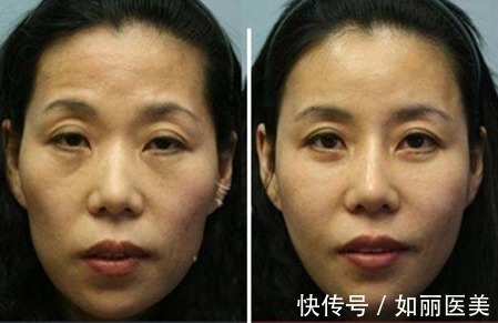 攻略 面部填充脂肪多长时间能恢复自然状态?价格&术后攻略送你参考!