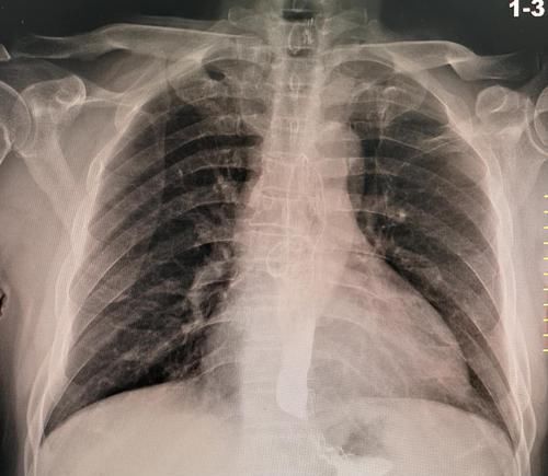 X光透视能查出肺结节吗？