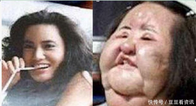 有钱没处花的女人 最后因为整容失败彻底毁容 快资讯