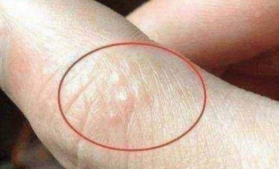 疱疹|手上出现此类“水泡”,切莫忽视,多半是“它”要来了!