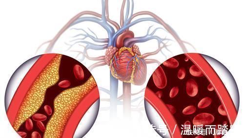 地平|不同人群的高血压，降压药选择不同，千万别选错！