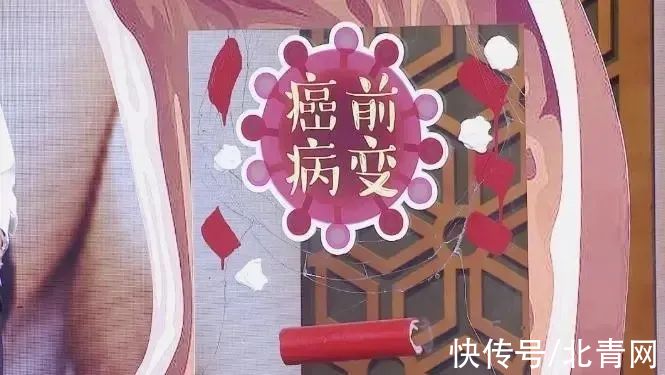 三脏同调法|查出结节、息肉，别掉以轻心，这几种情况易变成癌！中医调脏腑、化痰瘀、防癌变