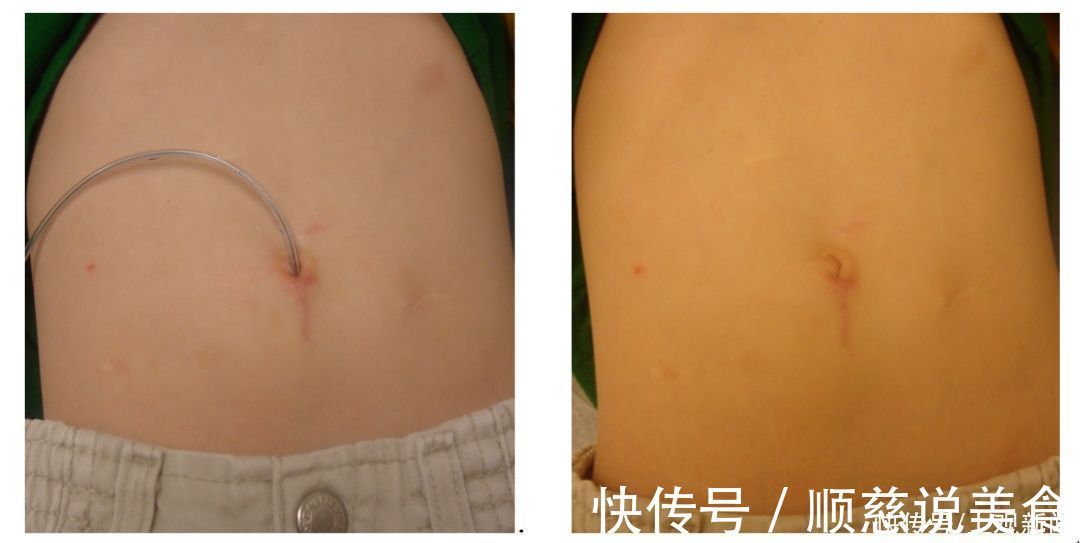 小仁|7岁男孩便便不受控,无法上学!马龙手术来解决,没有阑尾,还可造个