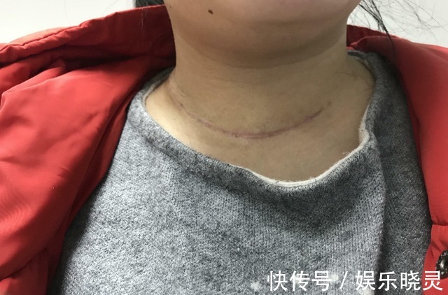 饮食习惯|一家四口先后查出甲状腺癌,“诱因”也许是这些菜,不妨了解一下