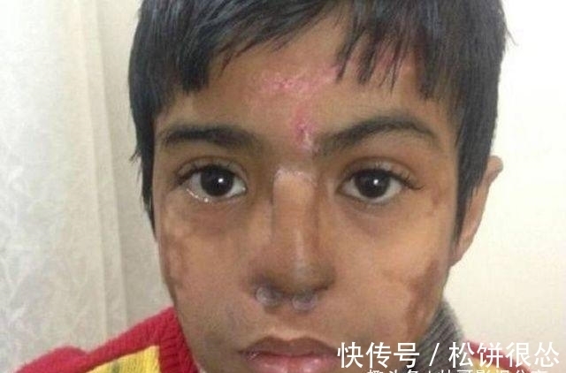 鼻子|国外小男孩鼻子长在额头上,看了他的经历,真是坚强的表率