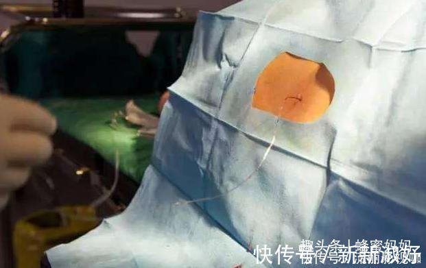 母爱|不打麻药“生剖”的剖腹产真实存在吗母爱的伟大,并非纸上谈兵